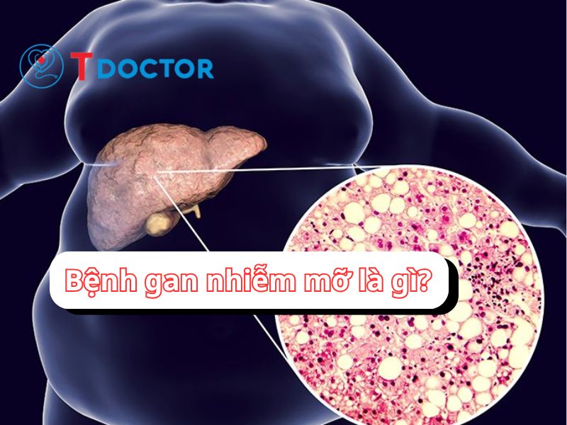 Bệnh gan nhiễm mỡ là gì? Bệnh gan nhiễm mỡ có lây không Bệnh gan nhiễm mỡ là gì? Bệnh gan nhiễm mỡ có lây không