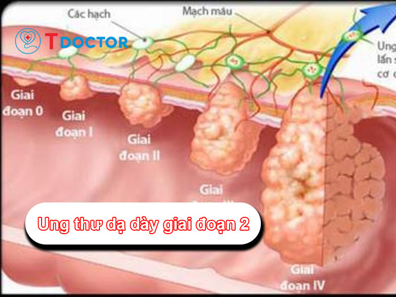 Ung thư dạ dày giai đoạn 2 và những điều người bệnh cần biết Ung thư dạ dày giai đoạn 2 và những điều người bệnh cần biết