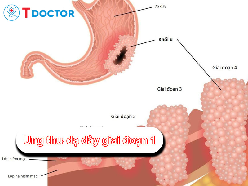 Những dấu hiệu ung thư dạ dày giai đoạn 1 mà bạn cần biết Những dấu hiệu ung thư dạ dày giai đoạn 1 mà bạn cần biết