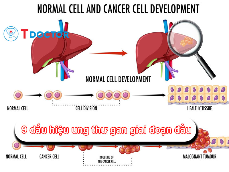 9 dấu hiệu ung thư gan giai đoạn đầu mọi người cần biết 9 dấu hiệu ung thư gan giai đoạn đầu mọi người cần biết