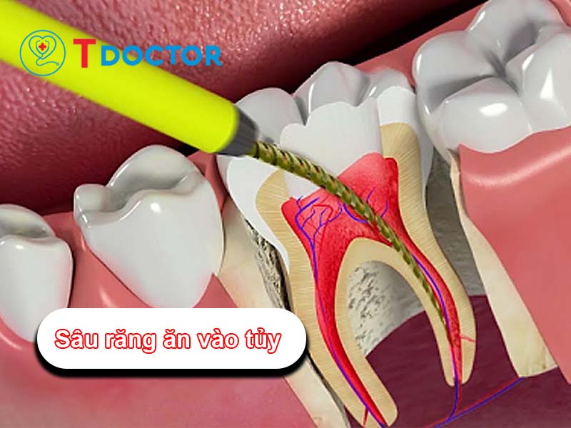 Dấu hiệu nhận biết sâu răng ăn vào tủy - cách chữa trị kịp thời Dấu hiệu nhận biết sâu răng ăn vào tủy - cách chữa trị kịp thời