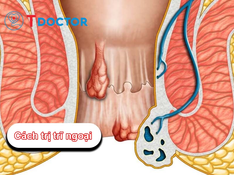 Có cách trị trĩ ngoại ngoại nào? Ưu và nhược điểm của chúng Có cách trị trĩ ngoại ngoại nào? Ưu và nhược điểm của chúng