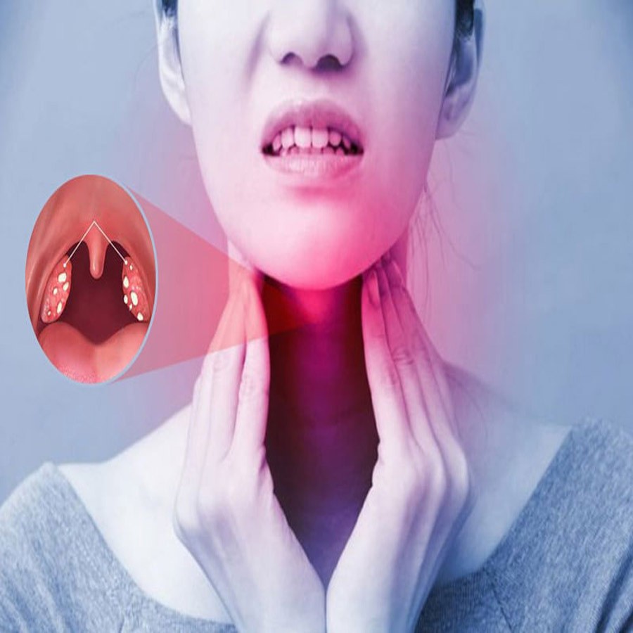 Người bị bệnh viêm amidan mãn tính thì phòng nhiễm covid 19 như thế nào?